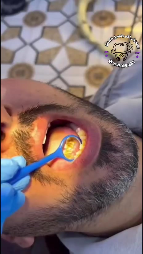 تم إجراء تنظيف دقيق للأسنان لمراجعنا، وإزالة الترسبات والكلس، لاستعادة نظافة وإشراقة الابتسامة 🦷
الكشفيه+الاشعه🔥مجانا 
للحجز***********
📍البصره_قضاء الدير-ناحيه النشوه(مقابل دائره النفوس)
