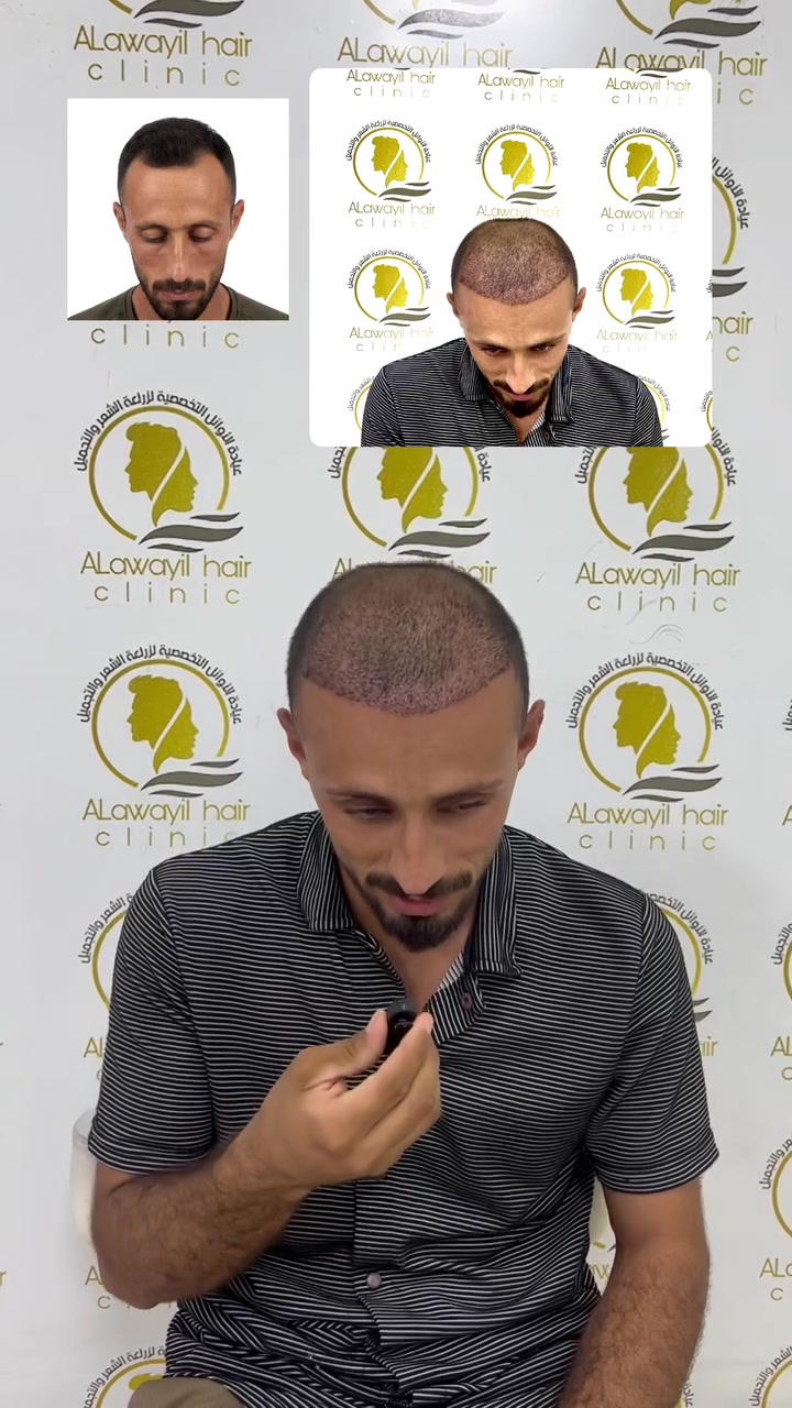 🔥الأوائل لزراعة الشعر خيارك الأفضل 

# زراعة بصيلات عدد مفتوح 
عرض الاوائل لفتره محدوده 
زراعة_بصيلات عدد مفتوح بضمان مدى الحياة
العيادة  الاولى على العراق بزراعة الشعر بكادر طبي متخصص

. زراعة شعر الرأس بتقنية الاقتطاف (FUE).
. زراعة اللحية والشارب.
. زراعة الحواجب.
. استشارة وتقييم حالة الصلع قبل العملية.
. متابعة المريض بعد العملية مع تعليمات العناية والغسل 
. ٦ جلسات بلازما مع ميزو 
. حقيبه علاجيه متكامله بعد العمليه 
تحاليل قبل العمليه مجانا

📍 عيادة الأوائل  لزراعة الشعر – النجف الأشرف

📞 للحجز والاستفسار: ***********
📩 راسلونا أو زورونا لحجز استشارتكم”

#viral #exploer #اكسبلورexplore #fypage
