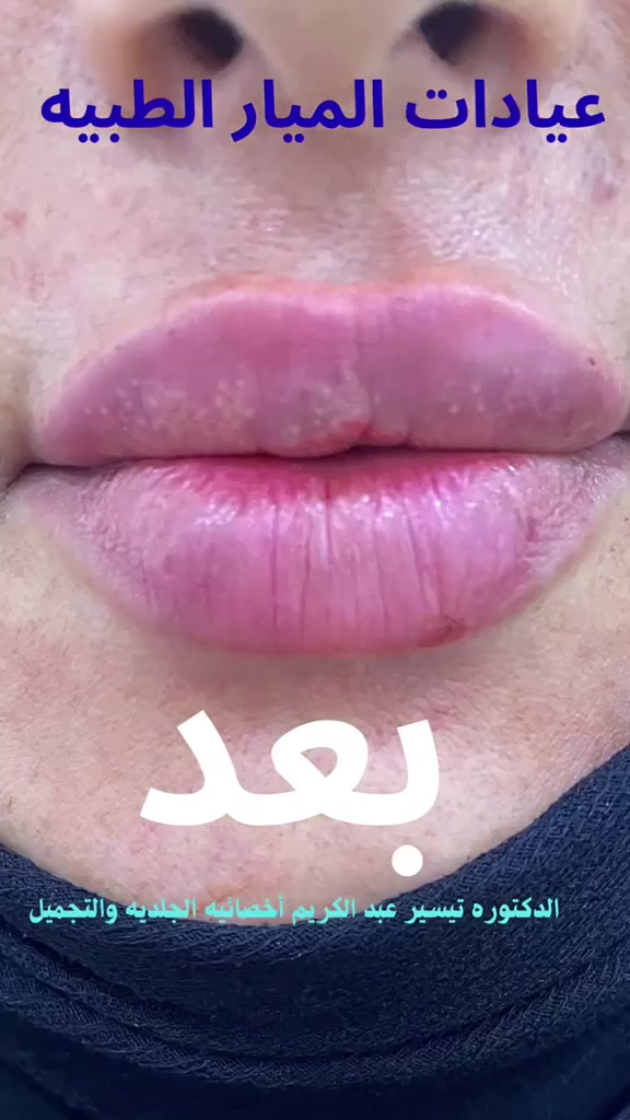 💋 لمسة بسيطة… وفرق واضح ✨

شاهدي نتيجة فلر الشفاه بإشراف الدكتورة تيسير عبد الكريم 🩺
أخصائية الجلدية والتجميل

✨ امتلاء طبيعي
✨ تحديد أجمل للشفاه
✨ تناسق مع ملامح الوجه

📍 عيادات الميار الطبية – المدائن
📲 للحجز والاستفسار: ***********

احجزي موعدك وخلي جمالك بلمسة احترافية 💕
