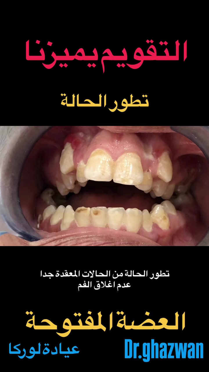 التقويم يميزنا من اعقد و اصعب الحالات العضة المفتوحة و عدم القدرة على اغلاق الفم يعاني من مظهر خارجي غير متناسق و عدم القدرة على تناول الطعام و تقطيع الطعام و صعوبة في الكلام و انزعاجات مستمرة و مشاكل صحية اخرى…. علاج جميع الحالات الصعبة و المعقدة نتائج مضمونة خبرة مميزة في علاج الحالات المعقدة ابتسامة مثالية اسعار مناسبة بالتقسيط المريح… دكتور غزوان مزهر بغداد الكرخ نفق الشرطة بداية شارع الاطباء عيادة لوركا فوق صيدلية كنز النفق متوفر واتس *********** #تقويمالأسنان #تقويم_الأسنان_قبل_وبعد #العضة_المعكوسة #العضة_المفتوحة #تقويم_الأسنان_والفكين @حشوات_الاسنان @حشوات_الجذور @زراعة_الاسنان
