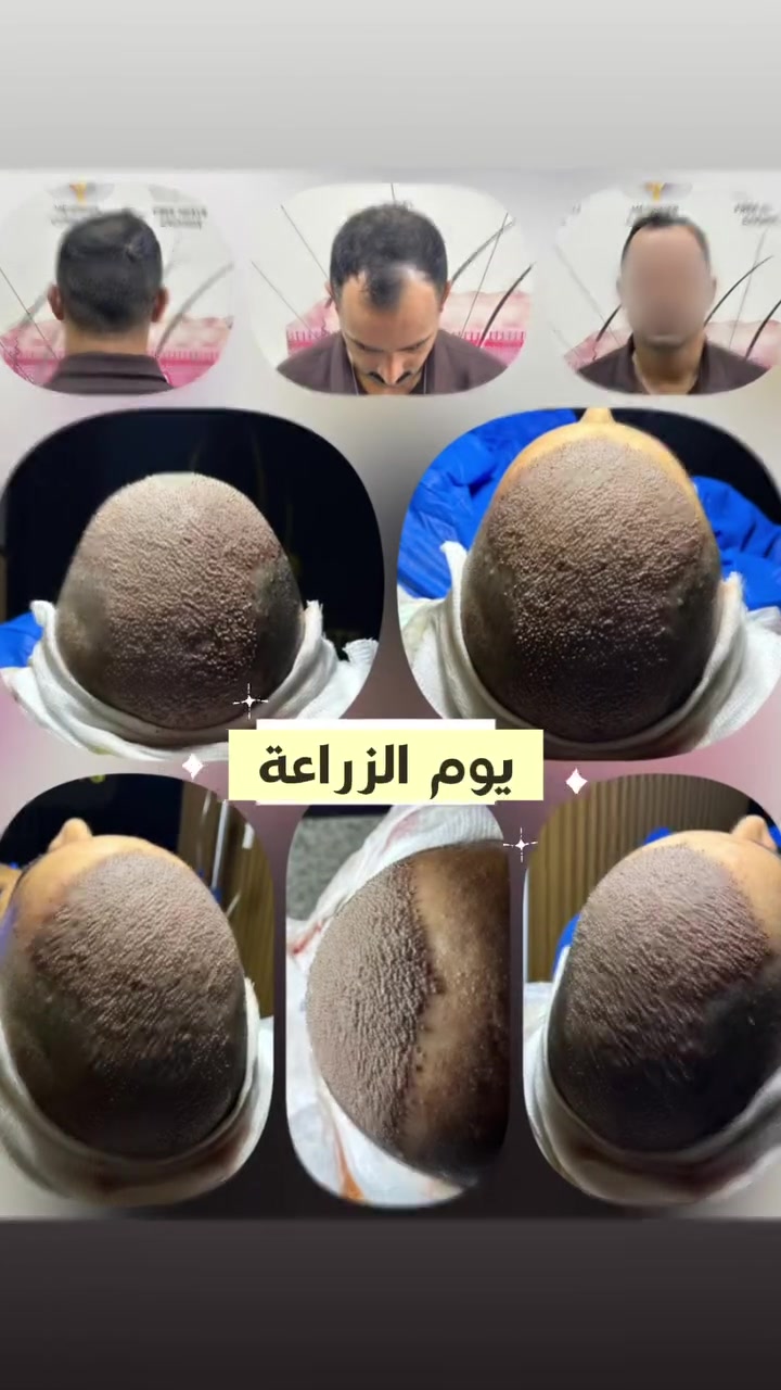 زراعة شعر • اقساط • ضمان مدى الحياة