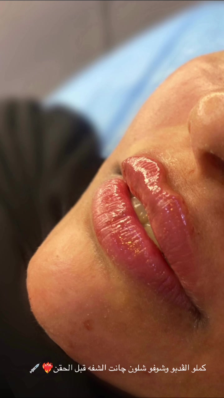 الفلر مو فقط تعبئه إنما هو تكنيك وتناسق 💋💉
د.شهد الزيدي 
☎️للحجز والاستفسار التواصل دايركت او عن طريق الرقم ***********

  #فلر_شفه   #بوتوكس #تجميل #نجف #نضاره

