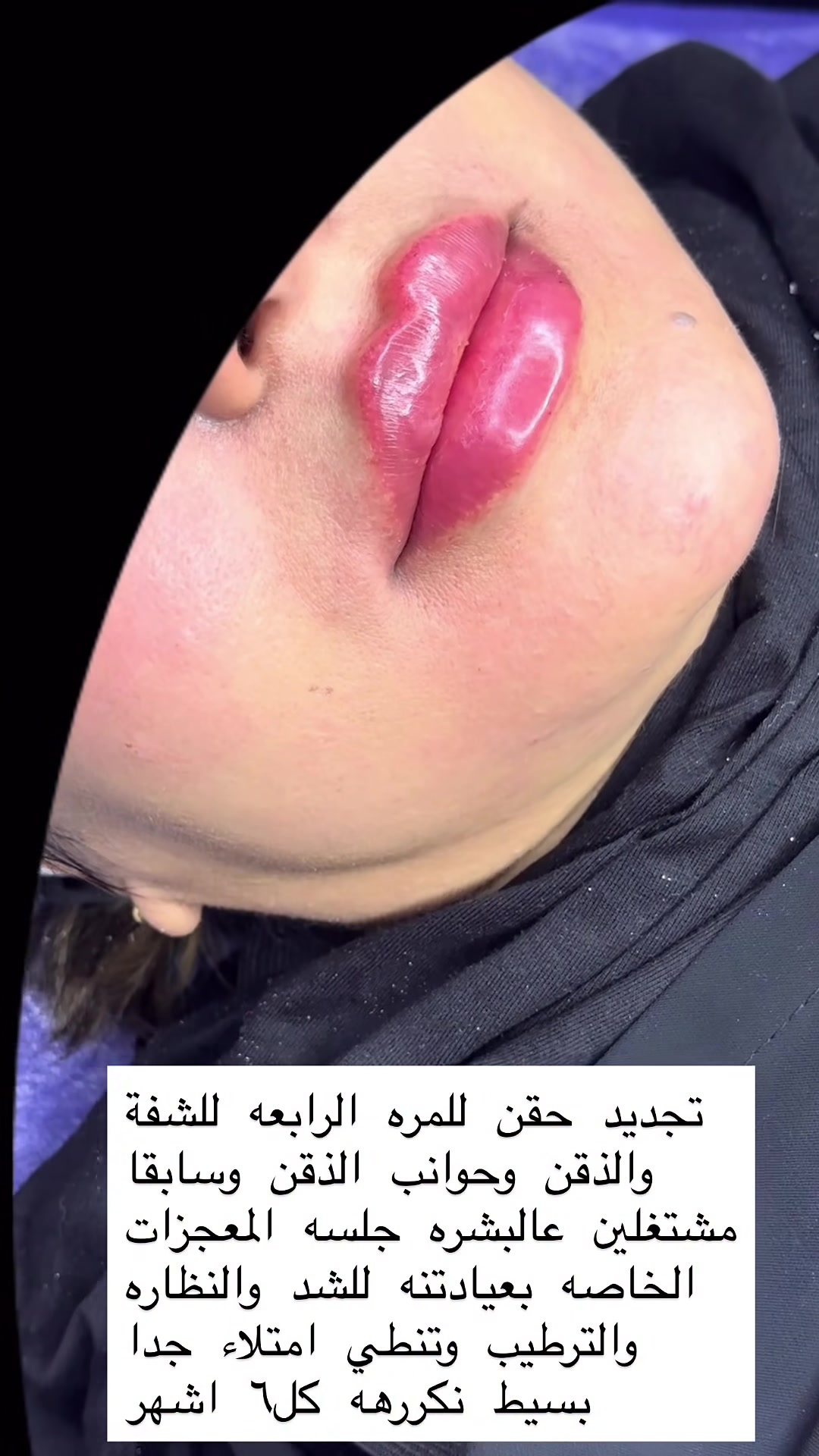 فلر شفة تجديد حقن(قلب وكبس) بالفلر السويسري🔥  

 سويتلكم عرررض مميز وقوي   للتغيير الشامل وجلسات السد والنظاره  راسلو الصفحة توصلكم العروض دايركت  🔥

د.ايثار سامي عبد الامير
الكوت_واسط _الهوره_مجمع القبطان

الحجز***********
