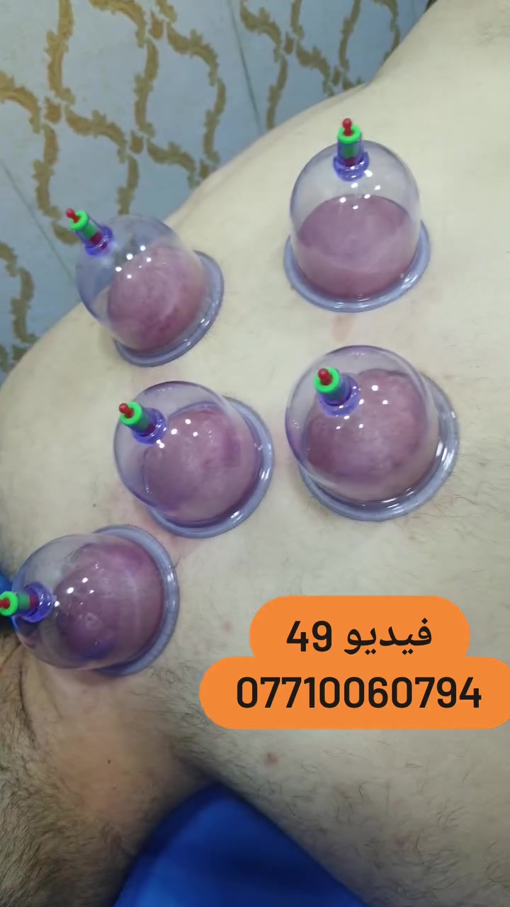 (فيديو جلسة حجامة) 49
العنوان بغداد_الكرخ الجعيفر_شارع الشيخ معروف قرب جامع رشيد دراغ
الحجز او الاستفسار ***********
 #طب_تكميلي #حجامة_رياضية #حجامةالطائي #مركزحجامةالكرخ
