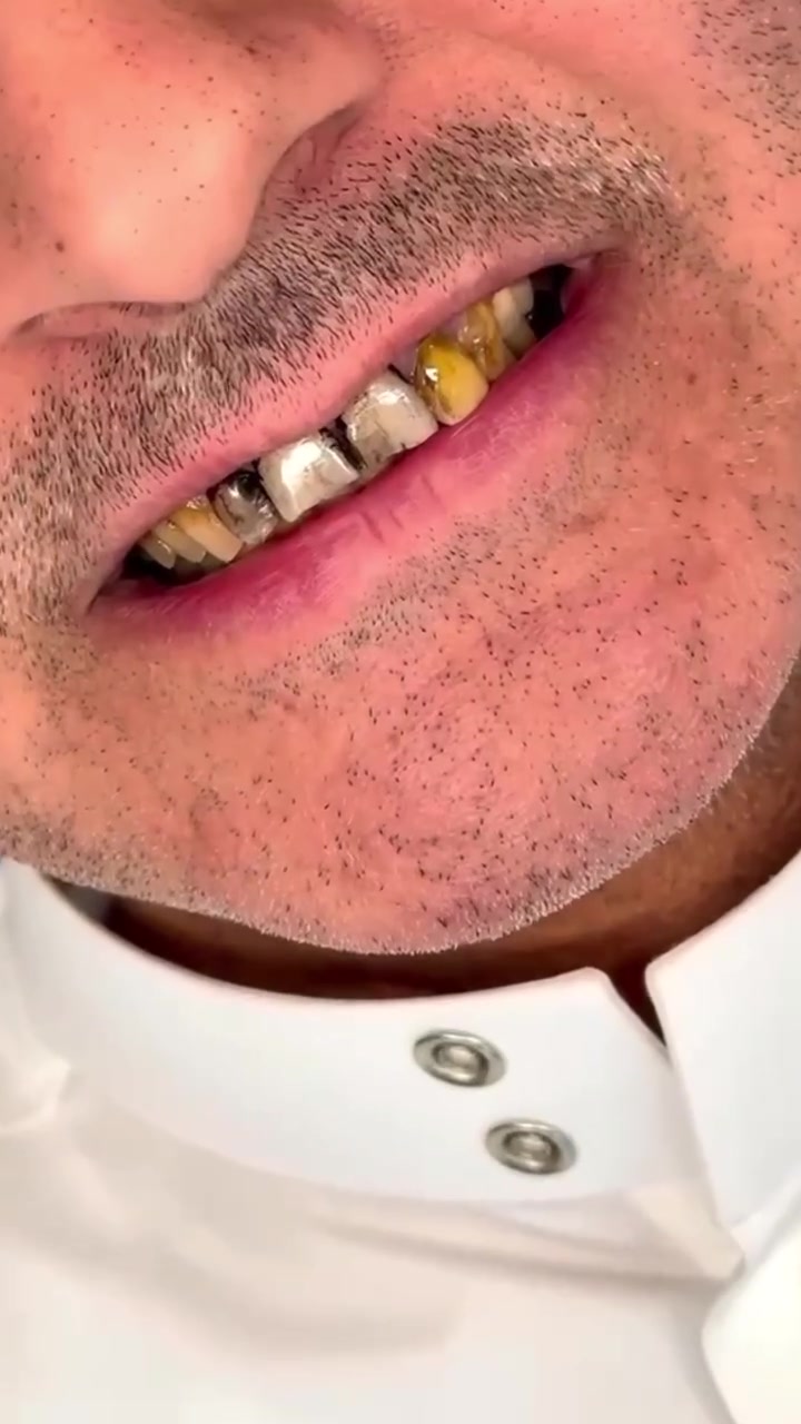 🦷✨ تغليف الأسنان
التغليف هو إجراء ترميمي يهدف إلى حماية الأسنان المتضررة أو الضعيفة واستعادة شكلها ووظيفتها، مع تحسين المظهر الجمالي للابتسامة.

يتم اختيار نوع وشكل التاج بما يتناسب مع حالة السن واحتياجات المريض، للحصول على نتيجة طبيعية ومتناسقة مع بقية الأسنان. 🤍

صحة أسنانك وجمال ابتسامتك… اهتمامنا الأول.

 للحجز والاستفسار راسلونا على الخاص.
العنوان البصره قضاء الفاو - سوق الفاو الجديد - مجمع الجهاد الطبي الطابق الثاني - فوق عياده د عادل عطيه .
الرقم / ***********
#ابتسامة_هوليود #الفاو #حشوات #ابتسامة #زراعة_اسنان ابتسامة_المشاهير
