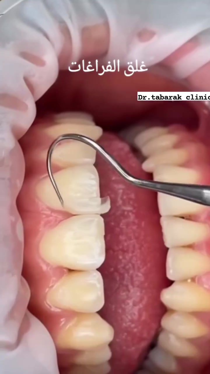 🦷✨ عيادة د. تبارك سليم العباسي لطب وتجميل الأسنان
نقدّم لكم رعاية متكاملة بأحدث الأجهزة والتقنيات، مع الاهتمام بأدق التفاصيل لضمان راحتكم وابتسامة أجمل.

🌟 خدماتنا: ✔️ فحص وتشخيص شامل ✔️ تنظيف وتلميع الأسنان ✔️ تبييض الأسنان ✔️ الحشوات التجميلية ✔️ علاج العصب ✔️ قلع الأسنان والجراحة ✔️ زراعة الأسنان ✔️ التركيبات الثابتة والمتحركة ✔️ التيجان والجسور ✔️ الفينير والعدسات التجميلية ✔️ ابتسامة هوليوود ✔️ تقويم الأسنان ✔️ علاج أمراض اللثة ✔️ أسنان الأطفال ✔️ البوتوكس والفيلر التجميلي
💎 نحرص على: 🔹 التعقيم وفق أعلى المعايير. 🔹 استخدام مواد أصلية وعالية الجودة. 🔹 أحدث الأجهزة والتقنيات العلاجية. 🔹 عناية دقيقة وراحة تامة للمراجعين. 🔹 أسعار مناسبة وخطط علاج تناسب احتياجاتكم.
📍 العنوان: (بسماية الشارع الخدمي قرب نخلة بغداد  مقابيل بيت بيوتي ) 📞 للحجز والاستفسار: ( ***********) 📲 راسلونا عبر الرسائل أو اتصلوا بنا لحجز موعدكم.

✨ ابتسامتكم هي عنوان ثقتنا... ونفخر بأن نكون جزءًا من رحلتكم نحو ابتسامة صحية وجميلة.
