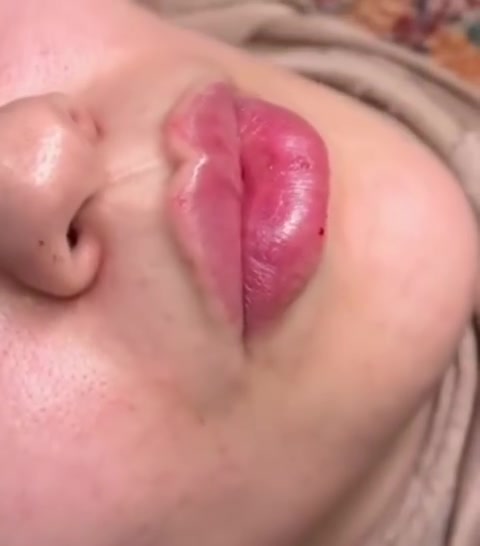 فلر ايطالي • جوفيدرم • تجميل