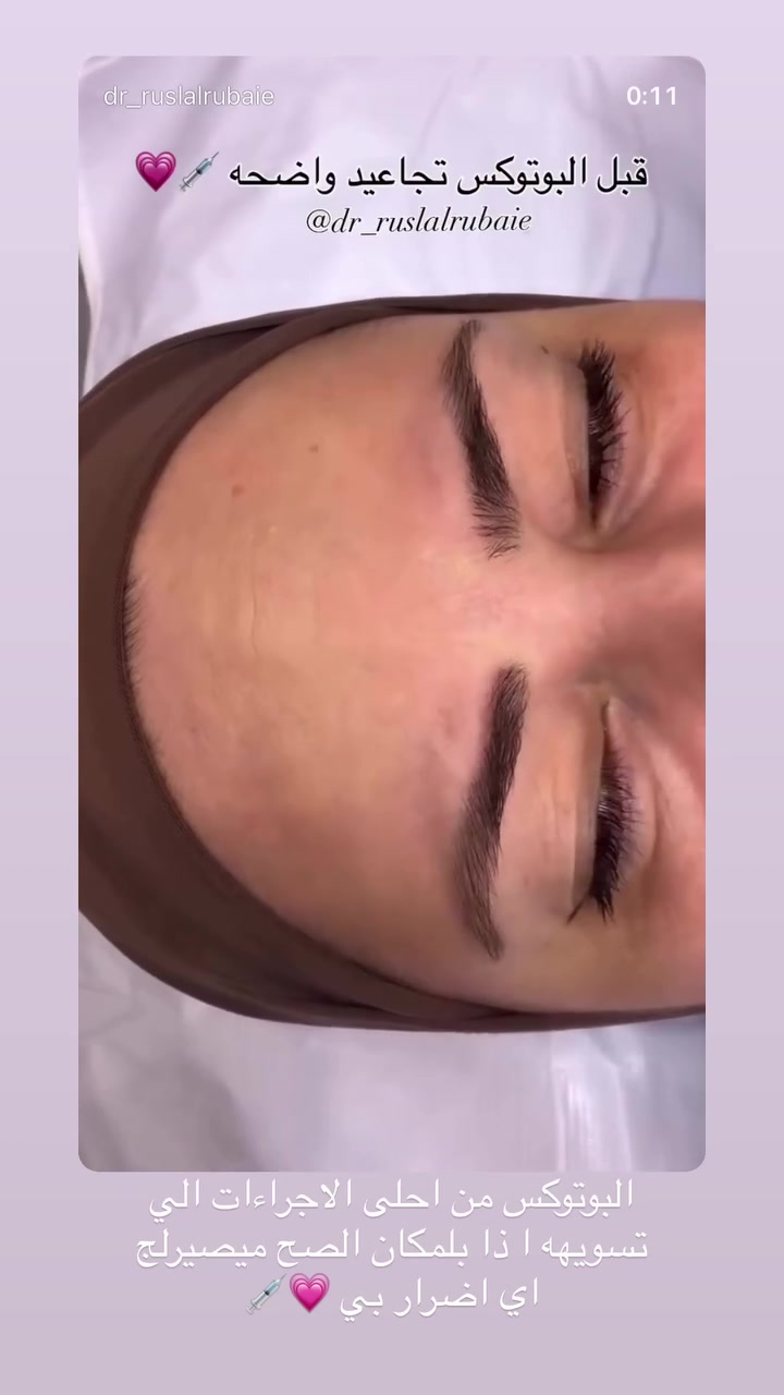صار هواي ممنزلتلكم رڤيوات مراجعاتي بسبب اللود 🤍💉
العروض مستمره اسبوع وتخلص 🤍💉 
بهاي العروض تكدرين تسوين تغيير شامل 
+ جلسات نضاره فري تحصلين 

💉ماشاءالله الاسبوع الي فات اقبال المراجعات على البوتوكس بشكل كبير 🤍💉

للحجز والاستفسار 
واتساب***********

او دايركت مسج فيسبوك DrRusl Alrubaie
او انستكرام

https://www.instagram.com/p/DbWWdUhsNAt/?stkn=Z2EwenVjcm5rOXFu
