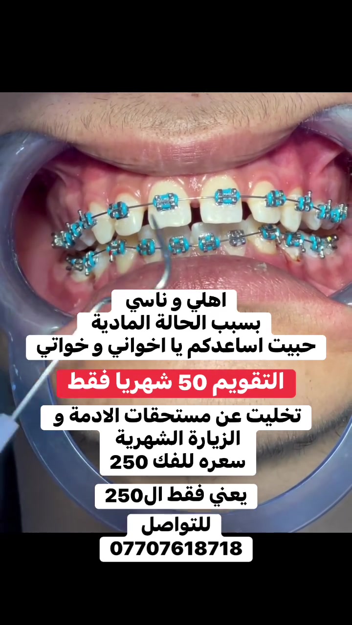 السلام عليكم ورحمة الله وبركاته 
اخواني حبيت اساعد الناس لان رب العالمين ما يضيع يمه شي
و اذا ما عندك راسل و تدلل 
.
.
.
.
.
.
.
.
.
.
.
.
 #تقويم #الانوار #اسنان
