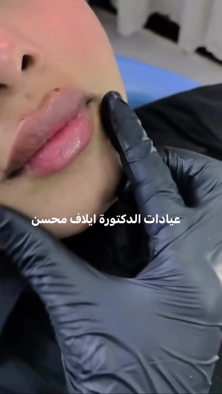فيلر شفايف • امتلاء ناعم • دكتورة ايلاف محسن