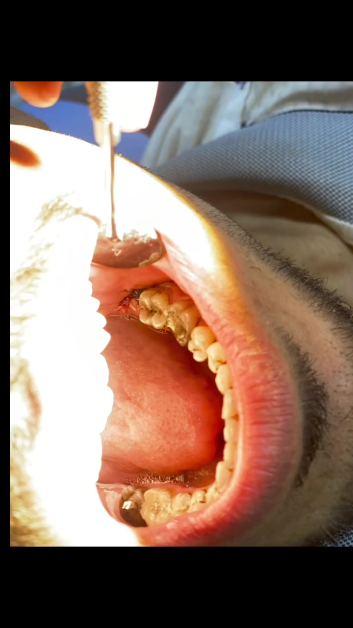 🔴🦷 ابتسامتك تستاهل اهتمام أكثر! ✨
في عيادة المجتبى للطب وجراحة الأسنان
نهتم بابتسامتك ونوفر لك عناية مميزة بأجواء طبية واهتمام بكل التفاصيل 🤍

🔴🔥 عروض خاصة تصل إلى 50% خصم — نصف السعر!

📍 الموقع: ناحية الحيرة، مقابل مدرسة السعدى، قرب صيدلية ساره 
📞 للحجز: ***********
💬 واتساب متوفر

ابتسامتك.. تهمنا �
