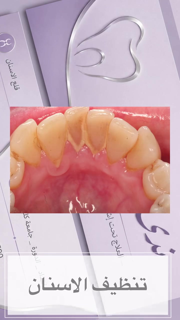 مجاناً • حشوات ضوئية • قلع الاسنان