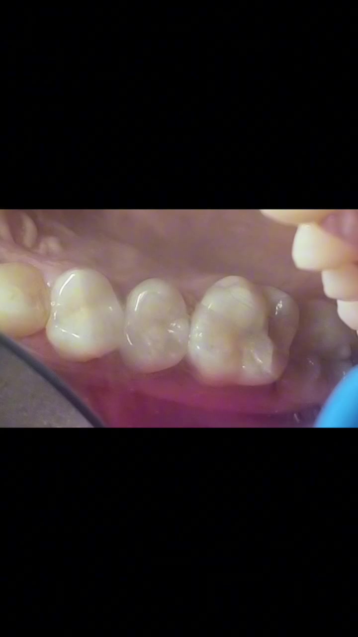 من أعمالنا اليومية في عيادتنا💙

حشوة ضوئية تجميلية✨🦷

#عيادة_كوثى_لطب_وتجميل_الاسنان
#الدكتور_علي_حسن_العزاوي 
جبله/نهاية شارع الاطباء
مقابيل الدكتوره ميثاق المعموري

***********//للاستفسار او مراسلة الحساب خاص
