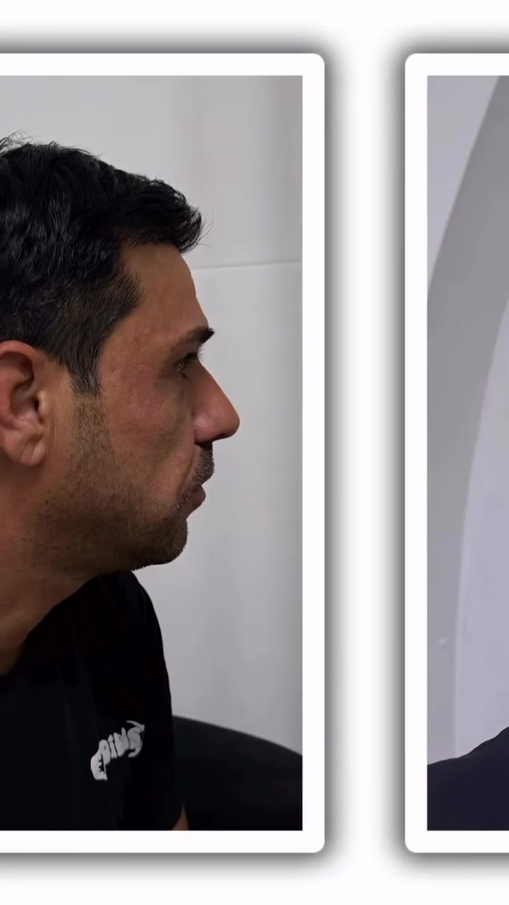 🔥🔥بعدك متردد بزراعة الشعر؟
خليها علينا… وإنت بس قرر تبدأ ✨

🔥بـ مركز الهلال التخصصي نهتم بكل تفصيلة، من أول معاينة لحالتك، لرسم خط الشعر، ولتوزيع البصيلات بطريقة تخلي النتيجة طبيعية وحلوة وتناسب وجهك ❤️

إذا تريد ترجع كثافة شعرك وثقتك بنفسك…
هذا وقتك

📲 دزّلنا رسالة واحجز موعدك�
***********
