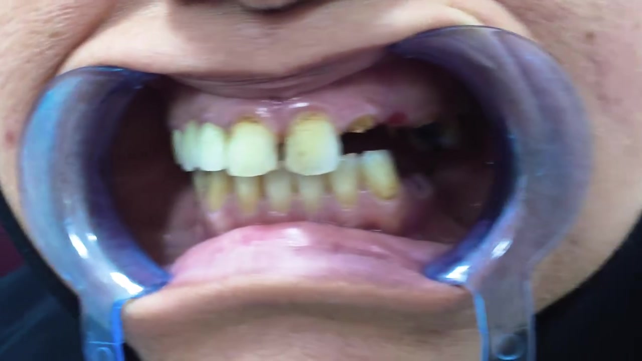 ✨ ابتسامة جديدة… وثقة من جديد ✨
من حالة تعاني من تهدّم وتساقط الأسنان إلى ابتسامة متناسقة وطبيعية 🦷🤍

تم إجراء العلاجات المناسبة وتركيب زركون عالي الجودة بعناية فائقة، مع الاهتمام بأدق التفاصيل الجمالية والوظيفية.

👨‍⚕️ الدكتور الأخصائي محمد نادر
📍 بغداد – العراق
***********

📞 احجز موعدك الآن وابدأ رحلة ابتسامتك الجديدة!

دقة في العمل… جمال في النتيجة.

