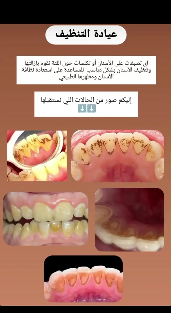 نقدّم لكم خدمات علاج الأسنان مجانًا وبإشراف أطباء مختصين، وبعناية واهتمام حتى تحصلون على ابتسامة صحية وجميلة 🤍🦷

نص مكتوب في الصور:
- الدكتورة زهراء خليل ابراهيم
- قلع الأسنان
- تنظيف الأسنان وإزالة التكسلات والتصبغات
- تركيب طقم أسنان جزئي متحرك
- الحشوات التجميلية
- العلاج مجاناً
- وبإشراف أطباء مختصين
- ***********
- شارع فلسطين - عيادات جامعه المصطفى
- قرب المستشفى العالمي
- لأن ابتسامتك تستحق الأفضل