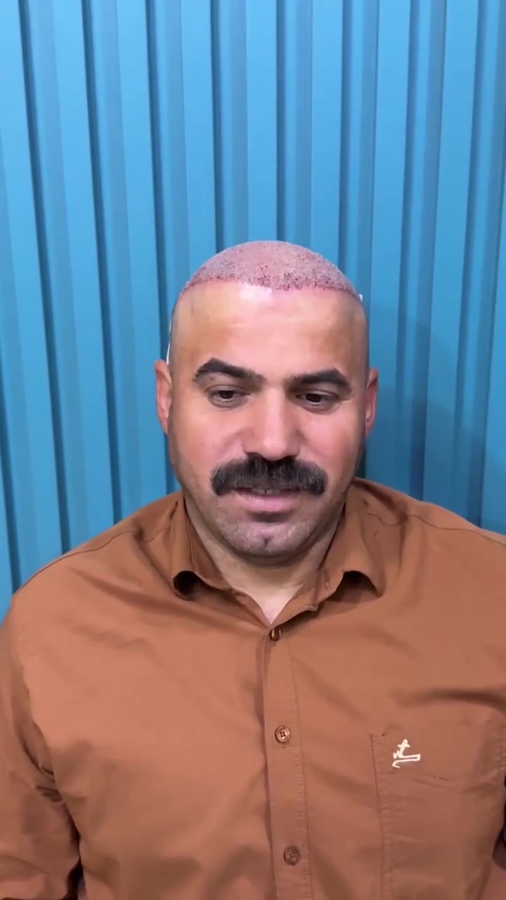 زراعة شعر • جلسة واحدة • بغداد اليرموك