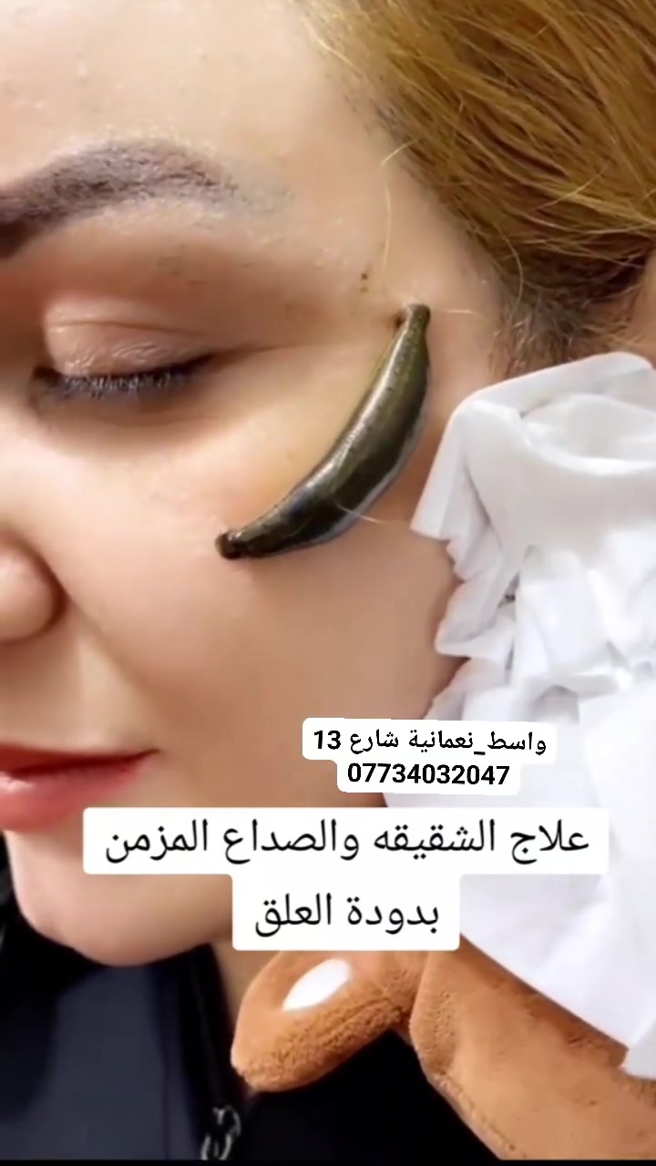 🩸 معالجة الشقيقة بالعلق الطبي 🩸
العلق الطبي Hirudo medicinalis يعالج الشقيقة والصداع، ويُستخدم ضمن جلسات علاجية لتحسين الدورة الدموية وتخفيف الأعراض.
👩‍⚕️ يوجد كادر نسائي 👨‍⚕️ يوجد كادر رجالي
📍 العنوان: محافظة واسط – قضاء النعمانية – شارع 13 مقابل دكتور علاء أبو سونار
📞 للحجز والاستفسار: ***********
#العلق_الطبي #معالجة_الشقيقة #الشقيقة #الحجامة_النسائية 
#الجميع
