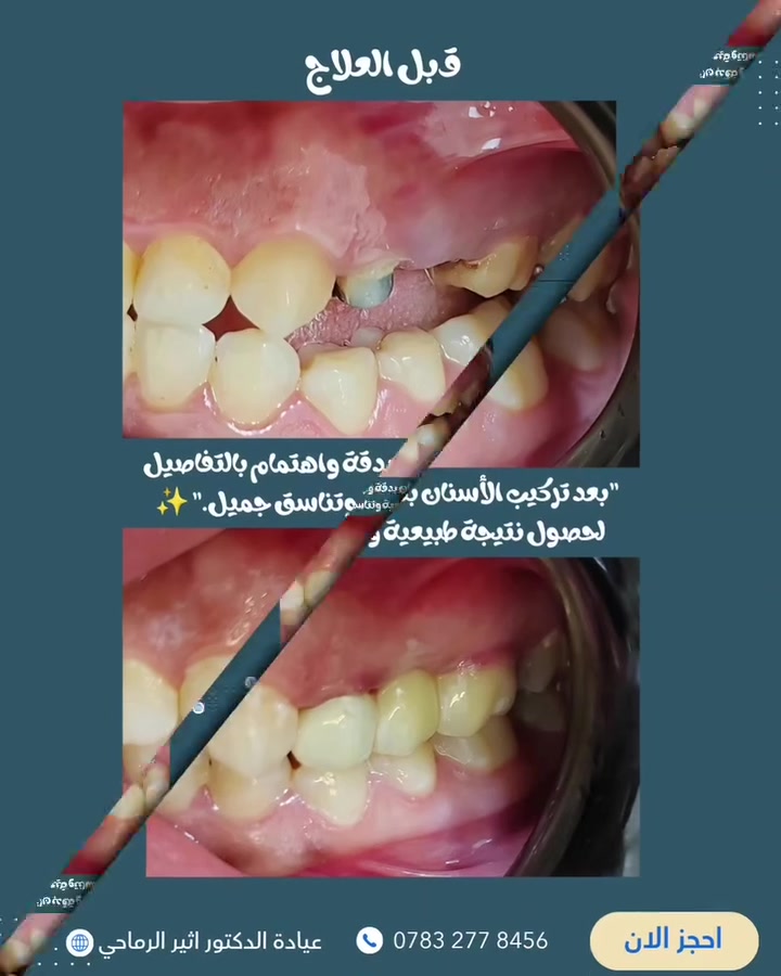 تركيب أسنان • زيركون • قضاء عفك