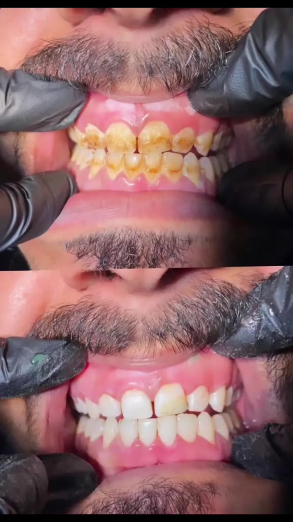 🦷✨ ابتسامتك تبدأ من هنا!
في مجمع السياب الطبي نقدم لك خدمات الأسنان بأحدث الأجهزة وعلى يد أطباء مختصين:
🔹 حشوات تجميلية
🔹 علاج عصب الأسنان
🔹 تنظيف وتلميع الأسنان
🔹 تبييض الأسنان (هوليوود سمايل)
🔹 تركيبات وأطقم الأسنان
🔹 قلع الأسنان وعلاج الالتهابات

📍 البصرة – خور الزبير –  الأسمدة – شارع المجمع
📞 ***********
📲 واتساب للحجز والاستفسار
