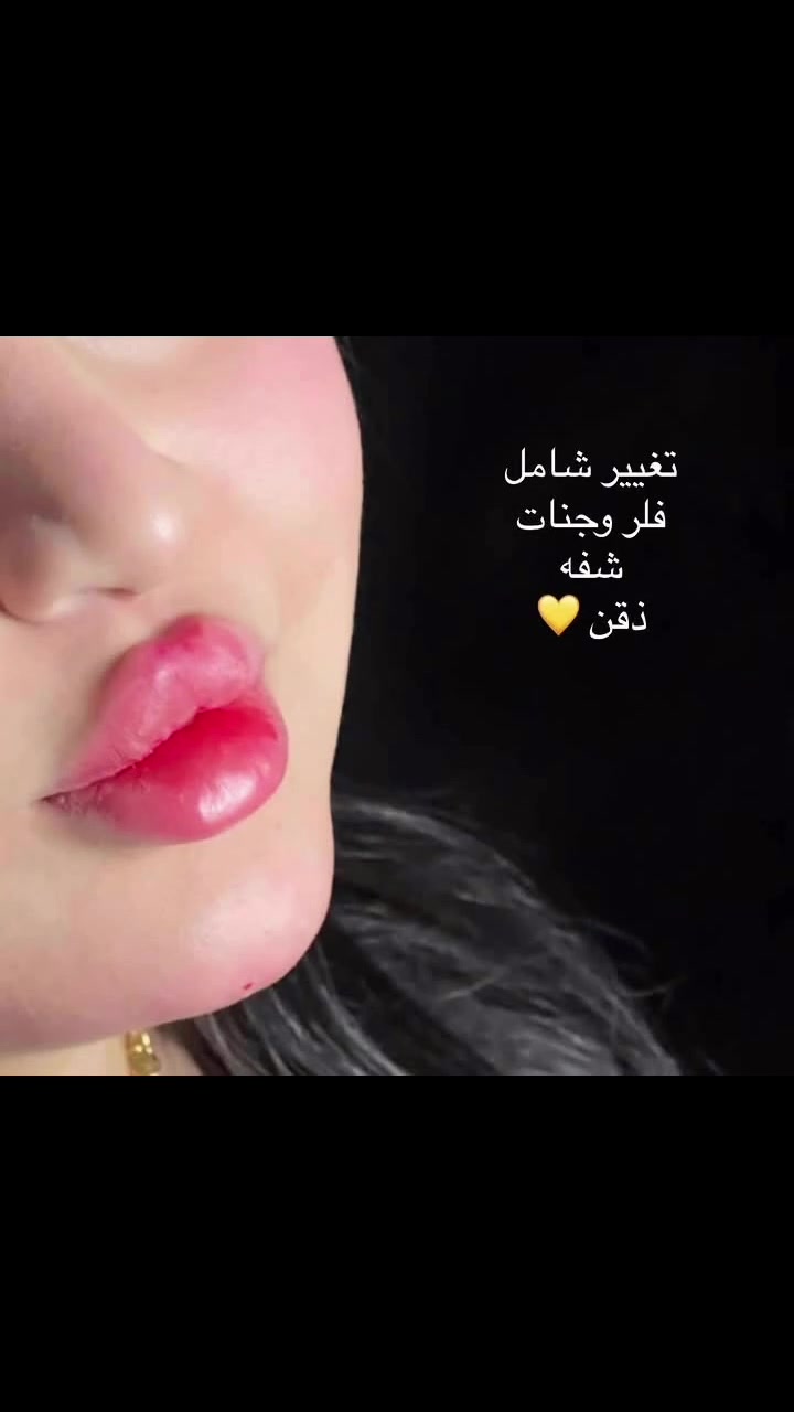 فيلر • تغيير شامل