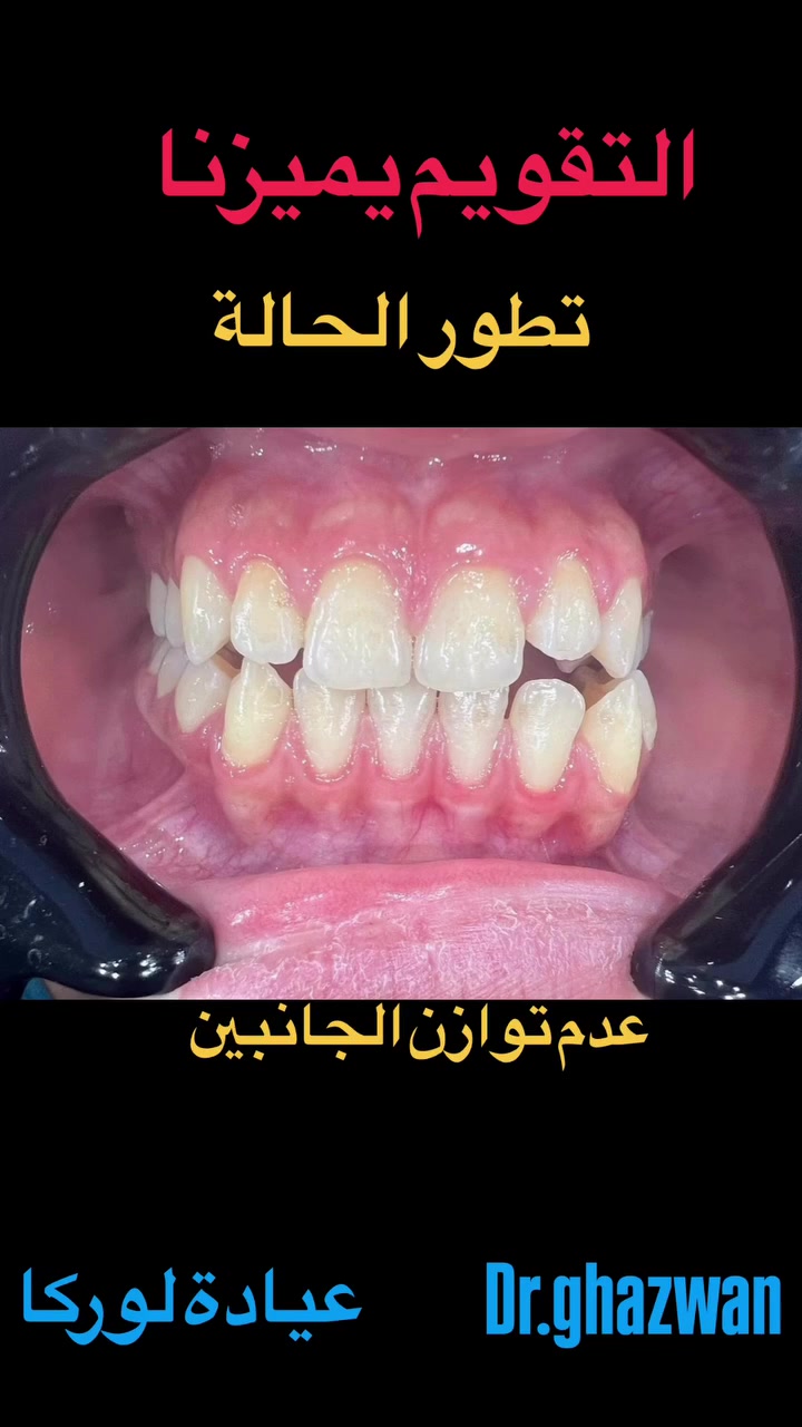 التقويم يميزنا احد اعقد الحالات عدم توازن الجانبين و الفكين يعاني من مظهر خارجي غير متناسق و عدم القدرة على تقطيع الطعام و مشاكل اثناء الكلام و انزعاجات اثناء النوم… علاج جميع الحالات الصعبة و المستعصية نتائج مضمونة خبرة متميزة دقة علاجية مصداقية في العمل ابتسامة مثالية… دكتور غزوان مزهر بغداد الكرخ نفق الشرطة بداية شارع الاطباء عيادة لوركا فوق صيدلية كنز النفق متوفر واتس *********** #تقويم_الأسنان_والفكين #تقويم_الشفاف_للأسنان #العضة_المعكوسة #تقدم_الفك_العلوي_السفلي #العضة_المفتوحة @حشوات_الاسنان @زراعة_الاسنان

