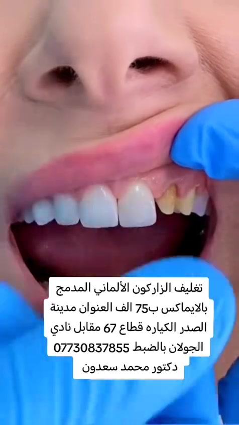 عيادة ايفا للتجميل والأسنان 💉🦷
العنوان #مدينة الصدر الكياره قطاع٦٧ مقابل نادي الجولان

‏‪***********‬‏📞
#اكبلور_العراق_السعوديه_الاردن_ايران_الكويت_طق_لايك_ات_كومنت_يلاا💜_فولو_بغداد_ميوزكلي_ #مدينة #فلر_شفايف #مدينةالصدر
