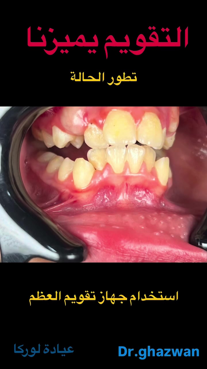 التقويم يميزنا احد اعقد الحالات تقدم الفك العلوي و تراجع الفك السفلي و العضة العميقة ماشاءالله مستمرون حتى نهاية العلاج التغيرات جدا واضحة الصور تتكلم …. علاج جميع الحالات الصعبة و المعقدة نتائج مضمونة خبرة طويلة في مجال الحالات المستعصية دقة في التشخيص إتقان العمل ابتسامة جميلة اسعار مناسبة بالتقسيط المريح… دكتور غزوان مزهر بغداد الكرخ نفق الشرطة بداية شارع الاطباء عيادة لوركا فوق صيدلية كنز النفق متوفر واتس *********** #تقويم_الأسنان_بأنواعه #العضة_المعكوسة #العضة_المفتوحة #العضة_العميقة #تقدمالفكالسفلي @تغليف_الاسنان_الزاركون @زراعة_الاسنان @حشوات_الاسنان
