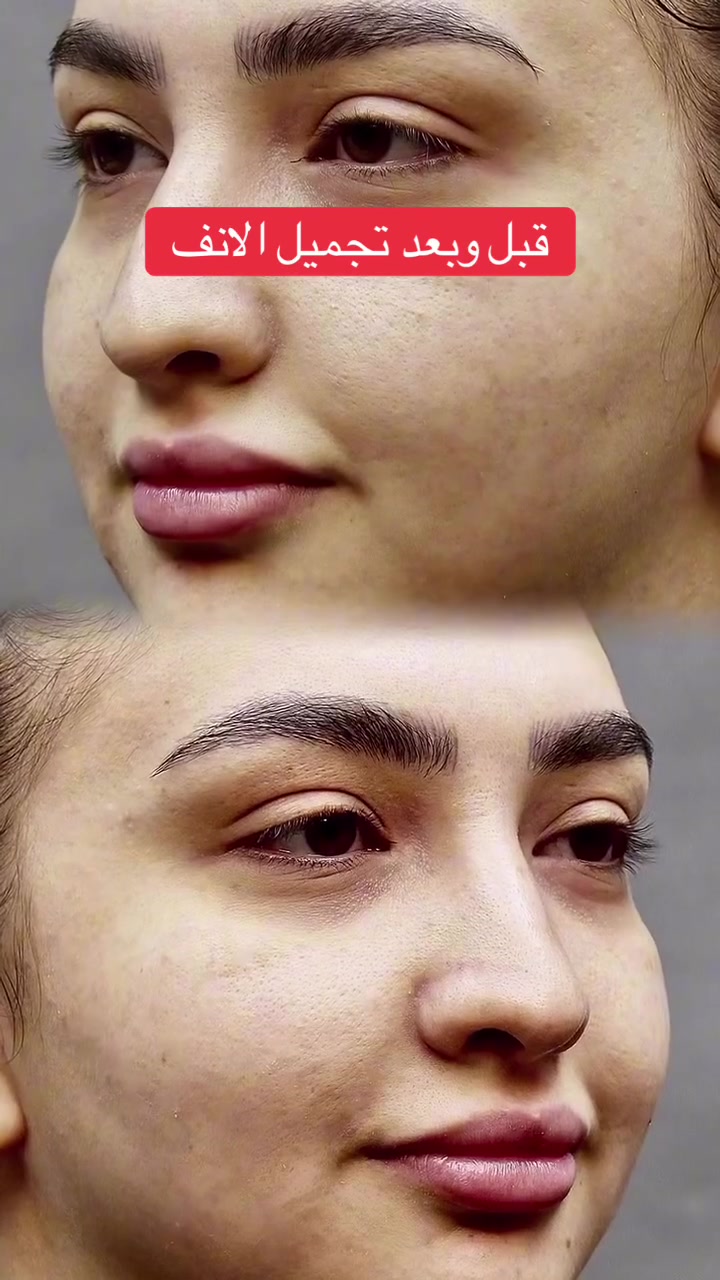 تجميل الانف • بروفيسور RASOULIAN • البصرة