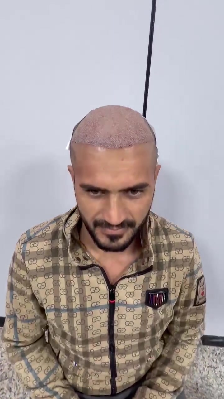 زراعة شعر • جلسة واحدة • تخدير بدون ألم