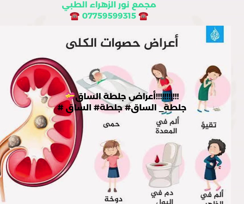 أعراض حصوات الكلى • د. جاسم الخزرجي • مجمع نور الزهراء