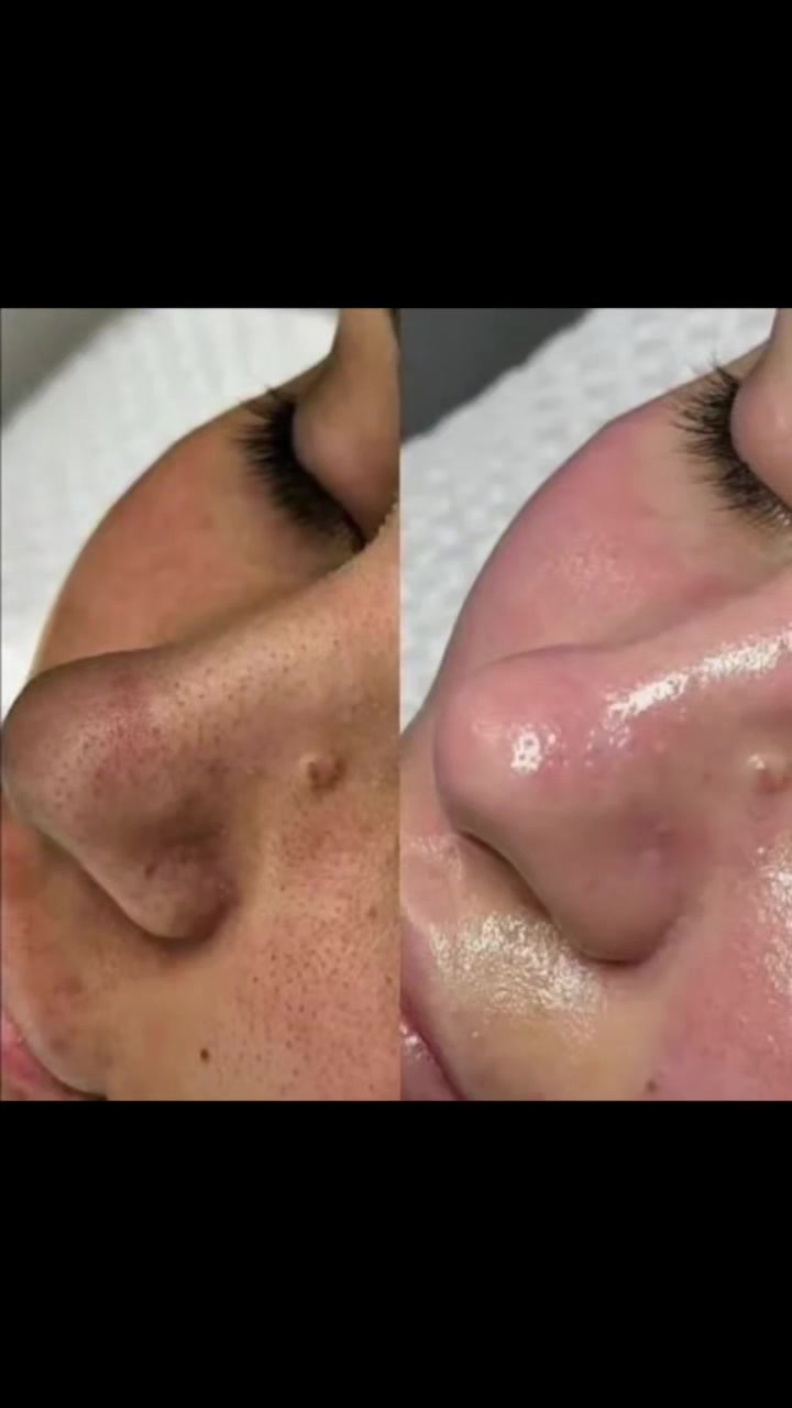 عرض حف تنضيف بشره ملكي ب جهاز لهايدروفيشل وتنضيف قدم مثل مشوفون كل هذا بس 25
حجز وات ساب ***********
