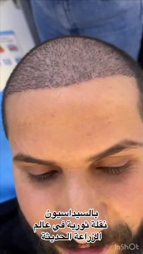 مو كل زراعة شعر… تُحسب زراعة.

بعد 10 أيام فقط من زراعة الشعر في مركز المتخصص، التفاصيل تبين من البداية:

بصيلات ثنائية • ثلاثية • رباعية
توزيع محسوب للكثافة،
اتجاهات مدروسة،
جوانب متناسقة،
وخط زراعة مصمم حتى ينسجم ويا ملامح الوجه.
Vip للشخصيات المهمة والمميزة فقط 
👇
لأن المستوى الـVIP  اختلاف جذري ،
يبدأ من البصيلة… ومن دقة التنفيذ.

✨ لمن تريد زراعة بمستوى مختلف، احجز استشارتك VIP.
مو كل حالة تنزرع بنفس الطريقة…
كل وجه إله تصميم، وكل بصيلة إلها مكان.

📞 للحجز والاستفسار: ***********

مركز المتخصص لزراعة الشعر
بالسيداسيون العجيب 🔥
الدقة هي أساس النتيجة.
