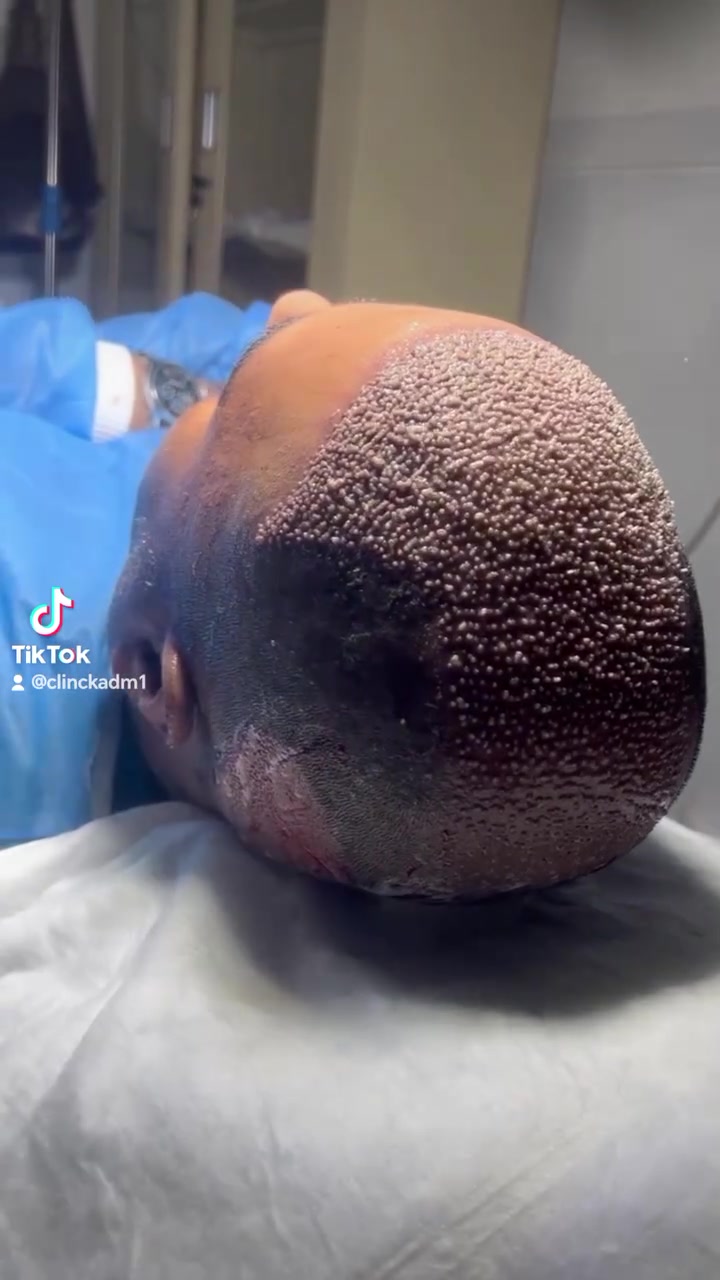 زراعة شعر • كثافة عالية • بغداد اليرموك