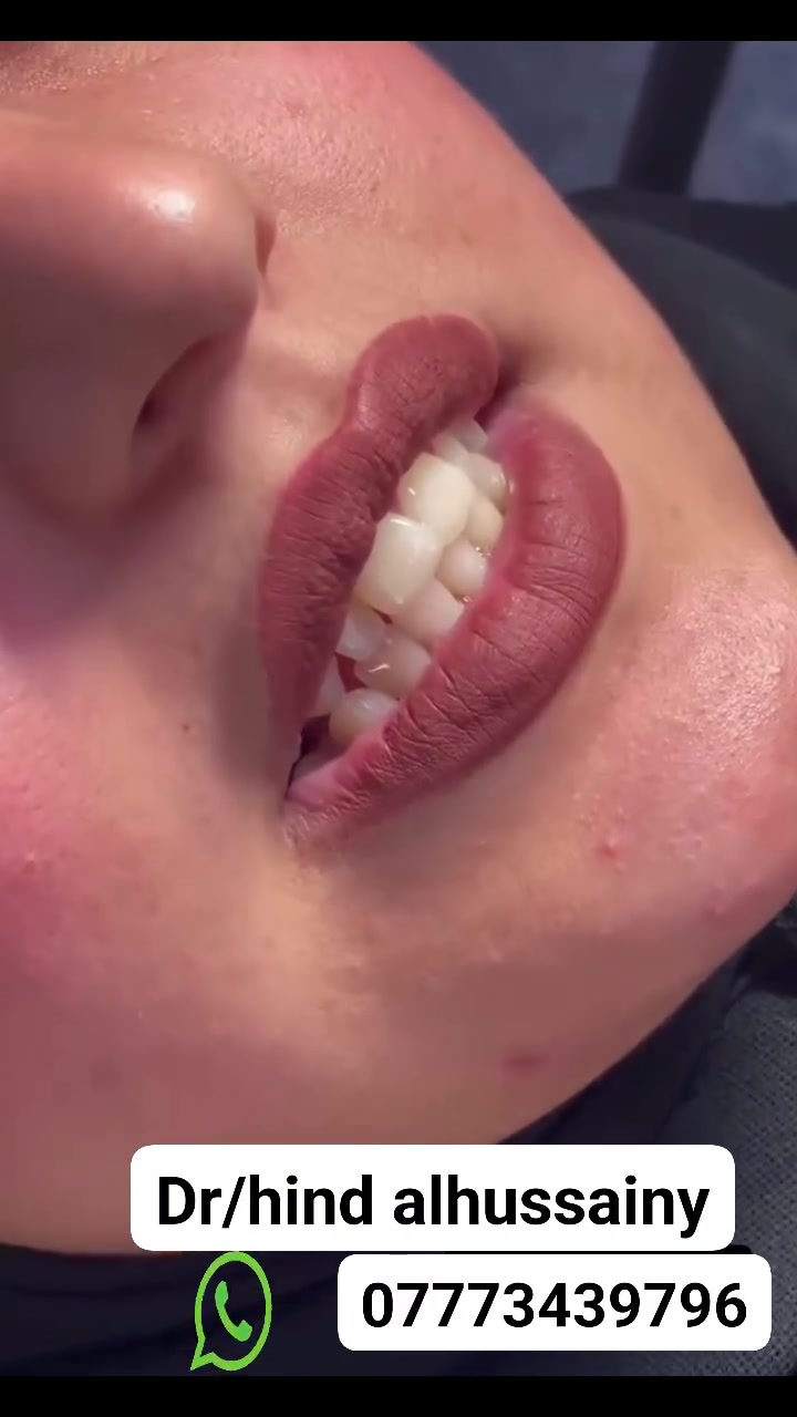 ✨ حلم الابتسامة صار حقيقة... وبدون برد للأسنان. 😍🦷
إذا حلمكم ابتسامة ناصعة وطبيعية وتحافظ على أسنانكم من البرد، فهذا الخيار إلكم 💜
📍 العنوان: بغداد – الأمين الثانية – تقاطع الزهور 
📞 للحجز والاستفسار: ***********
#ابتسامة_بدون_برد #فينير #ابتسامة_هوليود #تجميل_الأسنان @highlight #طبيبة_أسنان #بغداد #الامين_الثانية #دكتورة_هند_الحسيني
