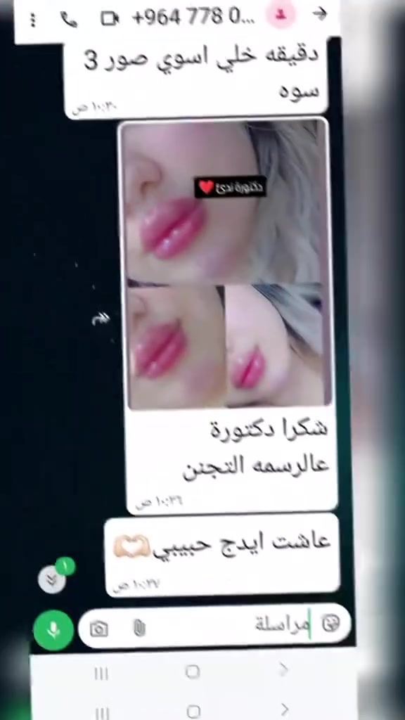 سما بيوتي • تجميل لاجراحي • بوتوكس فيلر