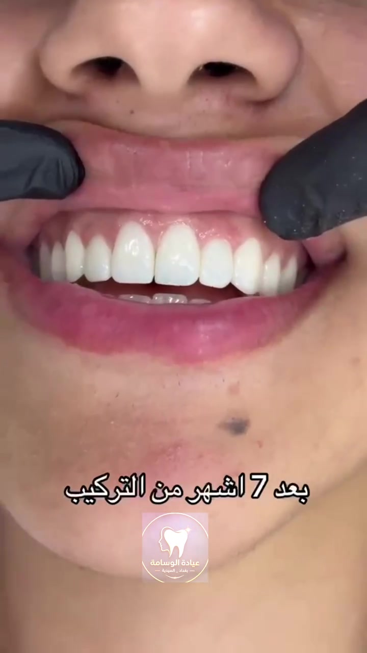 ابتسامة أحلامك وإطلالة أنيقة تبدأ من هنا! ✨🦷💖
يسعدنا في [عيادة الوسامة] استقبالكم وتقديم أرقى الخدمات الطبية والتجميلية بخبرة عالية واهتمام خاص.

​💎 خدمات طب الأسنان:
​تبييض الأسنان بالليزر للحصول على ابتسامة هوليوود ناصعة.
​زراعة وتلبيس الأسنان بأفضل الخامات العالمية.
​تقويم الأسنان وعلاج اللثة.
​العلاج التجميلي والترميمي بدون ألم.

​🌸 خدمات التجميل :
​جلسات النضارة 
ابر (فيلر، بوتوكس).

​أحدث تقنيات شد وتجديد شباب الجلد.
​📍 العنوان: 
[بغداد _ السيدية _ شارع الخيزران بجانب مازن كيتو]
📞 للحجز والاستفسار: 
​***********
​***********
💬 أو راسلونا مباشرة عبر الصفحة لتحديد مواعيدكم.

نص مكتوب في الصور:
- عيادة الوسام
- الدكتور
- محمود سامي الزبيدي
- لطب وتجميل الأسنان
- ***********
- ***********
- السيدية شارع الخيزران مجاور مندي
- بوابة اليمن وقابل قهوة ساو
- ابتسامة جديدة ثقة تدوم في عيادة الوسامة نهتم بكل تفاصيل ابتسامتك لنتائج طبيعية وتدوم طويلاً قبل بعد نتائج طبيعية ومضمونة مواد عالية الجودة وآمنة تكنولوجيا حديثة ودقة في العمل ابتسامة جميلة تغير حياتك للحجز والاستفسار *********** *********** عيادة الوسامة بغداد _ السيدية
- حشوات تجميلية استعادة الجمال الطبيعي لأسنانك قبل بعد تحافظ على صحة الأسنان نتائج فورية وجمالية حشوات آمنة وعالية الجودة مظهر طبيعي يندمج مع الأسنان ابتسامة أجمل .. ثقة تدوم
