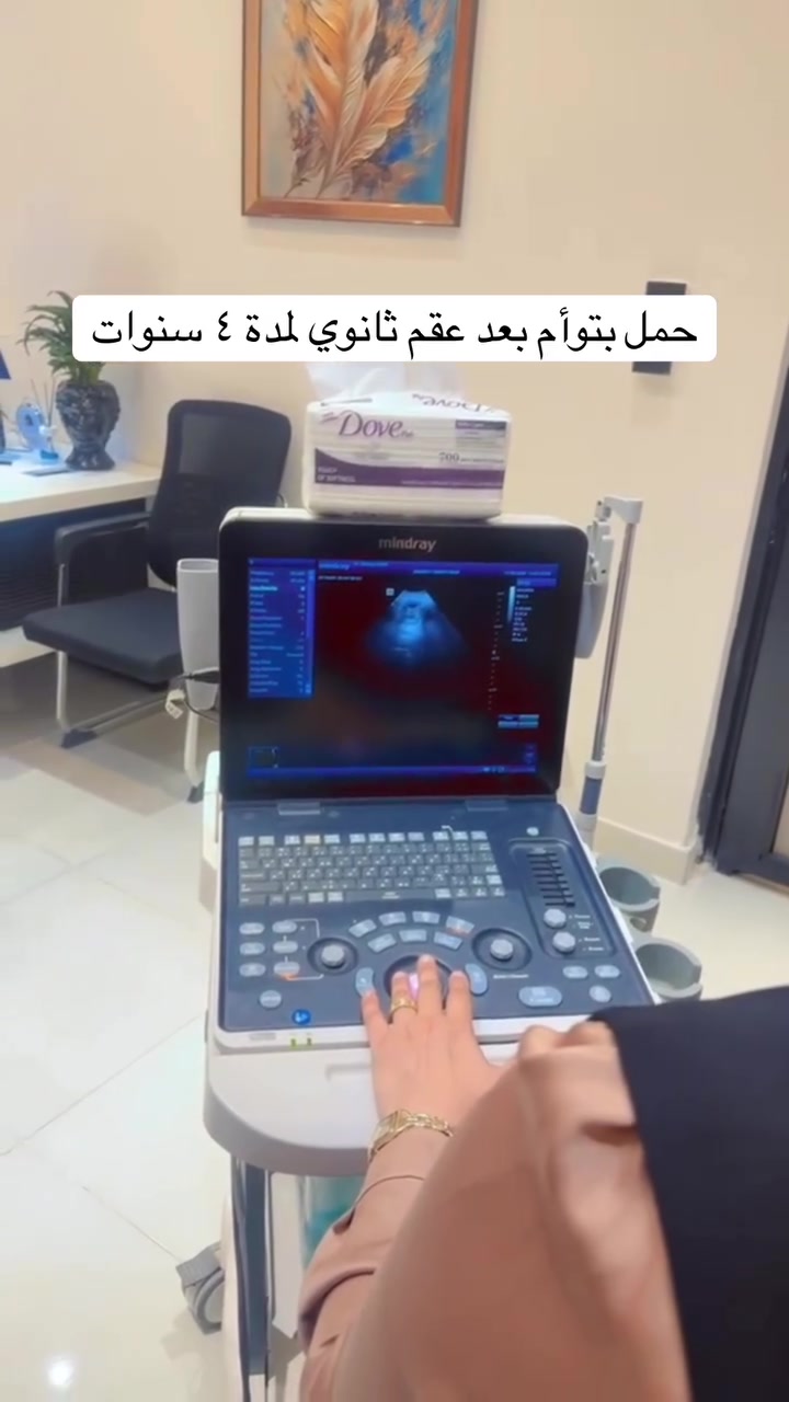 و تستمر افراح عيادتنا
الحمدلله حتى يبلغ الحمد منتهاه
فرحتي بمراجعتي الغالية ما تنوصف
اول ولاده الها ع ايدي
و بعدها عانت من عقم ثانوي لمدة ٤ سنوات
و كانت تراجع و التزمت ويانه بالعلاج و المراجعات و الحمدلله كنت سبب بفرحتها و رب العالمين كلل مساعينا بحمل تؤام 
ربي يتمم حملها ع خير و يفرحني بسلامتها هي و النونوات 
و ان شاءالله دوم نكون بفرحتكم و نفرح بيكم و وياكم ❤️❤️❤️❤️

الدكتورة زهراء صاحب الحميري 
اخصائية النسائية و التوليد و التجميل النسائي 
(رئيسة قسم النسائية في مستشفى الزعفرانية)

الزعفرانية/سوق مريم /فوق صيدلية الايناس
دوام العيادة : سبت و اثنين و اربعاء من الساعه ال٢ الى الساعه ال٨
نستقبلكم بكل حب و دمتم بصحة وعافية

رقم الحجز // ***********

#دكتورة_زهراء_صاحب #مستشفى_الزعفرانية #exploremore #اطفال #ولادات
