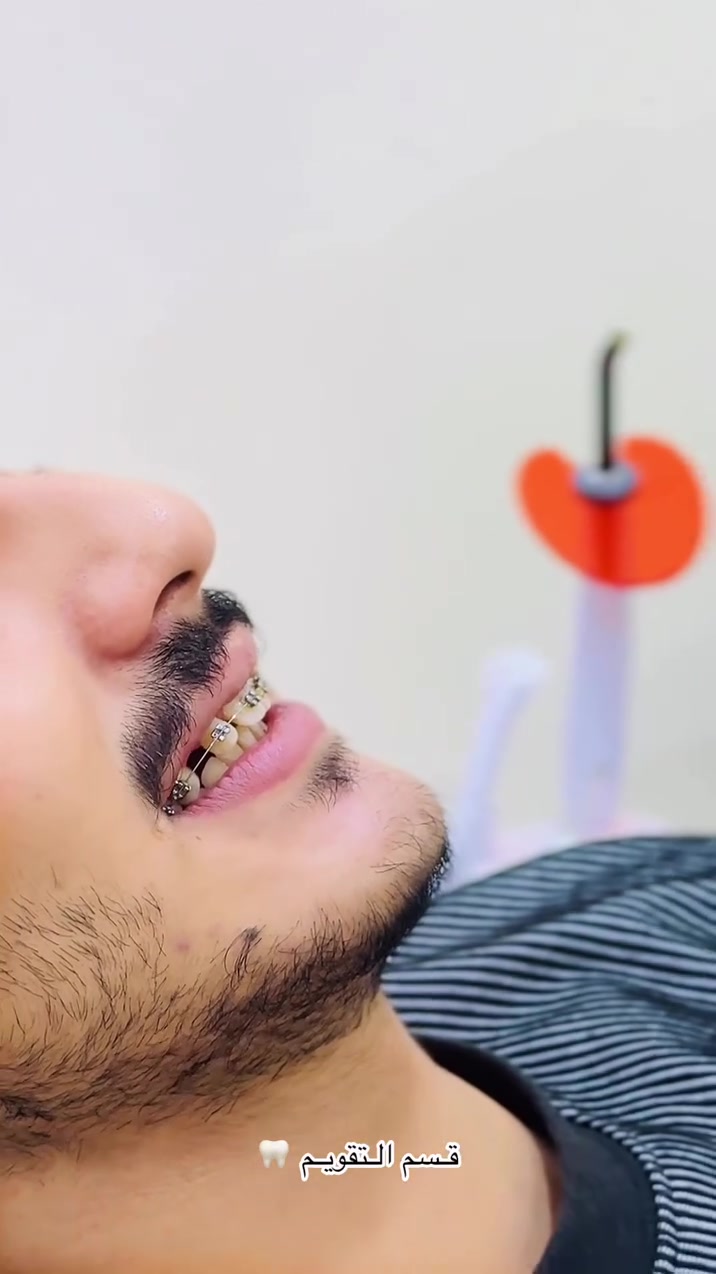 خطوة وحدة تفصلك عن أحلى ابتسامة بحياتك!
التقويم  صار اسهل هواي... بس تدرون شلون!! 🚀
لأن وفرنالك كل اللي تحتاجه بنقاط بسيطة:
​✨ مظهر أنيق وثقة بالنفس ما تتوقف.
​💵 أسعار تنافسية تناسب ميزانيتك تماماً.
​🔄 تسهيلات مالية ونظام تقسيط مريح.
​🩺 تشخيص دقيق باستخدام أحدث التقنيات.
​⏳ مواعيد مرنة تتوائم مع جدولك.
​المواعيد المتاحة محدودة، الحق مكانك اليوم! 🏃‍♂️
​

للحجز والإستعلام ⤵️
📱 *********** 

 📌 الناصرية - حي العسكري
