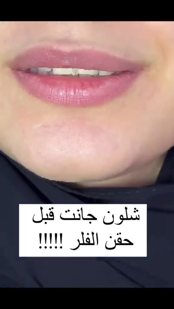 ✨ فيلر الشفاه… لمسة ناعمة تبرز جمال ابتسامتك 🤍
تحديد وترطيب وإطلالة طبيعية متناسقة 💋

📍 LAURA Clinics – الديوانية، قضاء سومر
📞 ***********
فيلر #فيلر_شفايف #فيلر_الشفايف #تجميل #تجميل_الشفايف #نضارة_البشرة #تجميل_طبي #عيادات_تجميل #LAURA_Clinics #الديوانية #سومر #تجميل_العراق #فيلر_العراق #جمال #عناية_بالبشرة
