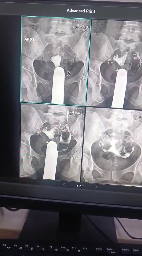 فحص تلوين الرحم 
عيادة الربيع للأشعه لكافة الفحوصات الشعاعيه العاديه والملونه وبأحدث الاجهزه الDR 
العنوان /سبع ابكار _قرب سوق السمكه_مقابل اعدادية الانتصار _عمارة صيدلية شمس الربيع للحجز ***********
#الكريعات #الاعظميه #الصليخ #بغداد #سبع_ابكار
