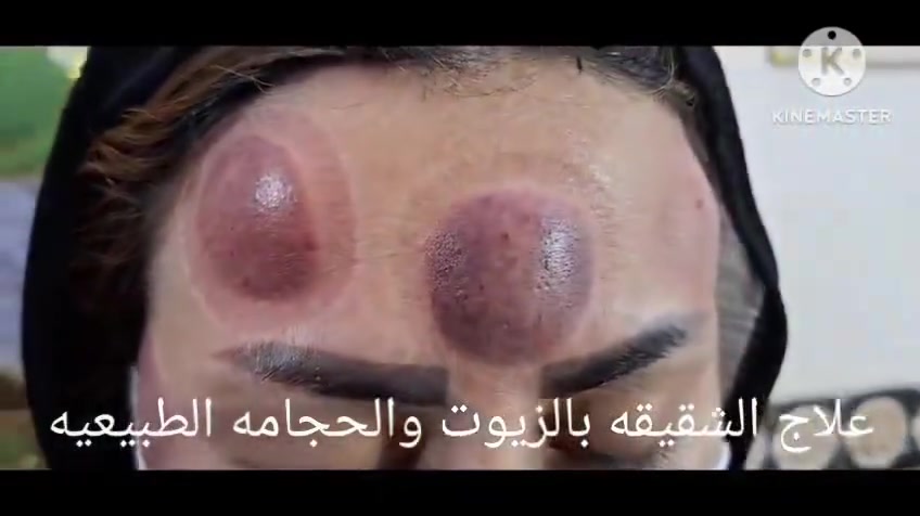الحجامة النبوية • مساج علاجي • طوريج