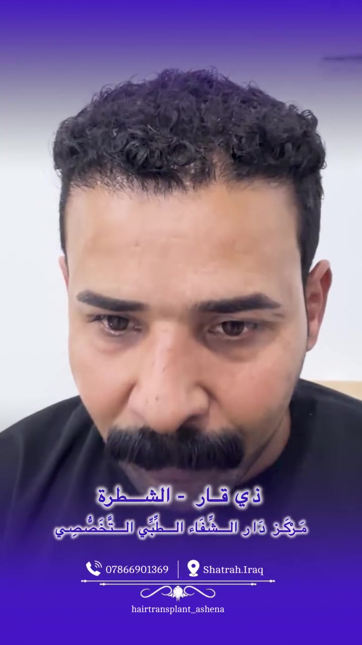 بعد مرور سنة كاملة على زراعة الشعر، التقينا اليوم بأحد مراجعين مركز دار الشفاء حتى نسمع منه عن تجربته بنفسه 🤍

شنو رأيه بالزراعة بعد سنة؟
شلون كانت تجربته ويانا؟
وشلون يشوف النتيجة بعد مرور سنة؟

خلي صاحب التجربة يحجيلكم بنفسه عن تجربته ويانا 🌱

📍 مركز دار الشفاء الطبي التخصصي
ذي قار – الشطرة
📞 ***********

#زراعة_الشعر #الشطرة #ذي_قار #مركز_دار_الشفاء #نتائج_زراعة_الشعر
