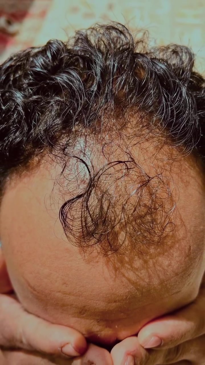 إحدى نتائج زراعة الشعر لأحد مراجعين بايدر فرع البصرة، واللي تعكس الفرق بين بداية الرحلة والنتيجة اللي وصل إلها.

إذا كنت من البصرة وتفكر بزراعة الشعر، خلي خطوتك الأولى أقرب مما تتوقع.

احجز استشارتك في بايدر– فرع البصرة

📍 مركز بايدر – فرع البصرة 
🏥 البصرة – تقاطع الجزائر – مستشفى الحياة – الطابق السابع

📞 للاستفسار والحجز: 
***********
***********
