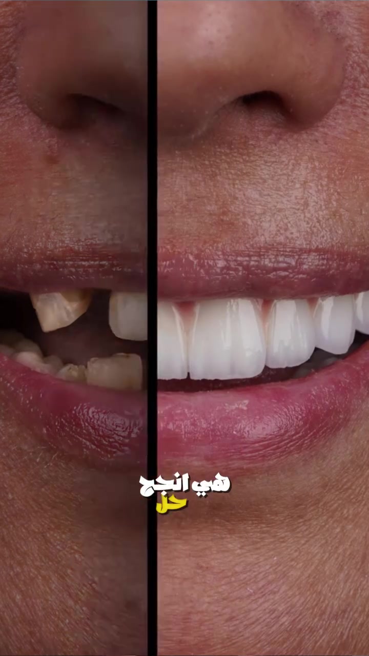 إذا فقدت سن، مو معناها لازم تتعود على الفراغ 🦷✨
زراعة الأسنان ممكن تكون خيار لتعويض السن المفقود واستعادة الشكل والوظيفة بشكل قريب من الأسنان الطبيعية، بعد تقييم الحالة من الطبيب.

لأن كل ابتسامة تستاهل ترجع كاملة 🤍

📍 عيادة درين – الحسينية، شارع المكاتب، مجاور صيدلية العجلان
📞 ***********
📞 ***********

#عيادة_درين #زراعة_الأسنان #تعويض_الأسنان #طب_الأسنان #ابتسامة #الحسينية
