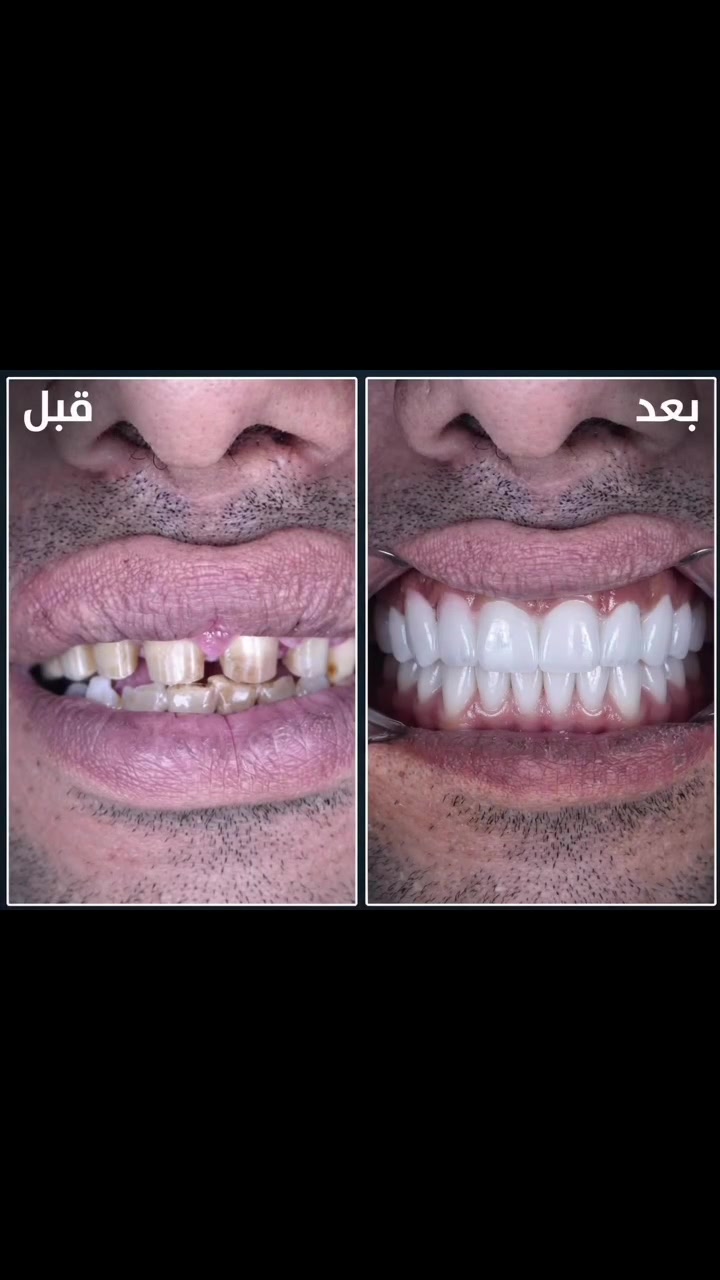 إعاده تأهيل للفك والابتسامة والثقة للمراجعة القصه قصة تغيير حياة  وليست فقط ابتسامة  عادية ابتسم دائماً ❤️
الشغل الصح ✅ بالمكان الصح✅🫡

(زراعة-تقويم-تغليف-تركيب)

#ملاحظة ضمان مدى الحياةأدواتنا استخدام واحد فقط

المياه المستخدمة أثناء المعالج معقمة(كاسات) 

للحجز والاستفسار مراسلة الصفحة أو الاتصال على الأرقام التالية ☎️*********** _***********

#اسنان #زراعة #تقويم #تغليف
المحمودية بغداد مدينة_الصدر

تيك توك 👇👇👇
￼https://www.tiktok.com/@mstk520?_t=ZS-8vKXPDhbuIm&_r=1

انستا 👇👇👇
https://www.instagram.com/lmrkzlswryltby/
profilecard/?igsh=Y2d5ODJ5Z3YwNWl3
