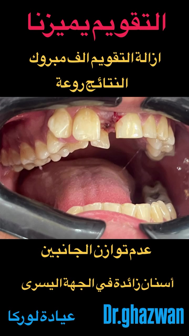 التقويم يميزنا احد اعقد و أصعب الحالات عدم توازن الجانبين بسبب وجود اسنان زائدة في الجهة الأخرى يعاني من مظهر خارجي غير متناسق و عدم القدرة على تقطيع الطعام و مشاكل أثناء الكلام و انزعاجات و عض اللسان و الخد من الداخل … علاج جميع الحالات المعقدة و المستعصية نتائج مضمونة خبره علمية متمكنة للحالات المعقدة دقة في العلاج دراسة علمية لكل حالة… دكتور غزوان مزهر بغداد الكرخ نفق الشرطة بداية شارع الأطباء عيادة لوركا فوق صيدلية كنز النفق متوفر واتس ***********#تقويمالأسنان #تقويم_الشفاف_للأسنان #تقويم_الأسنان_قبل_وبعد #العضة_المعكوسة #تقدمالفكالسفلي @حشوات_الاسنان @حشوات_الحذور @زراعة_الاسنان
