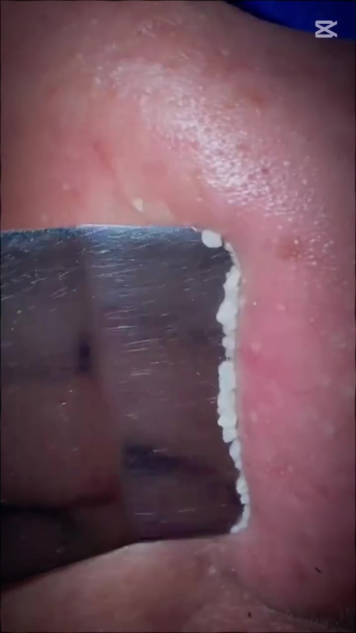 جلسة تنظيف بشره (هيدرافيشيل) في أيقونة 🦋كلا الجنسين
من فوائد #هيدرافيشل للوجه👌🏻
بجانب الهدف الرئيسي المتمثل في تنظيف البشرة وإزالة الأوساخ المتراكمة فيها ومنحها مظهراً جذاباً نابضاً بالحياة،
 من فوائد الفيشل للوجه لبعض الحالات التي تعاني من مشاكل جلدية✨
_ تنظيف البشرة السطحى والعميق🧼
_ تقشير البشرة💆🏻✨
_ شد البشرة وتفتيح وتقليل المسام وازالة الترهلات من الوجه

متوفر يومـيا 🤍🫣
هيدرافيشل ١٠الاف🫣
✨____________________✨

الحجز واستفسار على ارقام 👇🏻
***********
العنوان المحموديه....مجمع المصطفى ....اسواق المصطفى 💗
