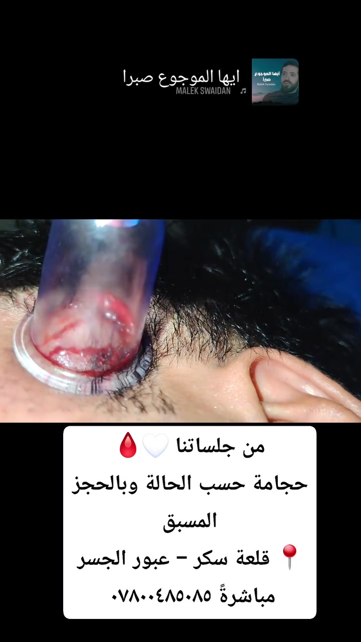 حجامة حسب الحالة وبالحجز المسبق 🤍
📍 ذي قار – قلعة سكر – عبور الجسر مباشرةً
📞 ***********
#حجامة #حجامة_علاجية #قلعة_سكر #ذي_قار
