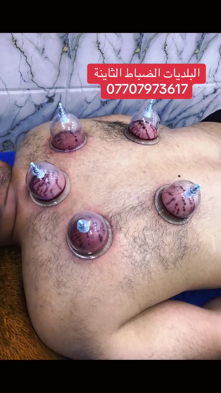 حجــــامة علاجية 
البلديات الضباط قرب المحطة الصفره 
***********
